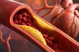 Cholesterol After a Stroke: Why It Matters and How to Manage It