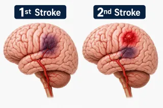 What Causes a Second Stroke?