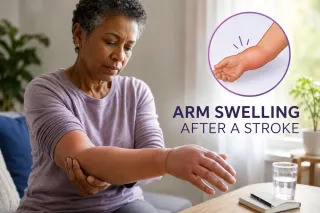 Arm Swelling After a Stroke