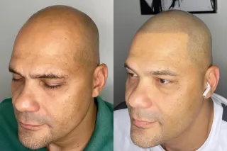 Scalp Micropigmentation Explained: How SMP Restores a Natural Hairline