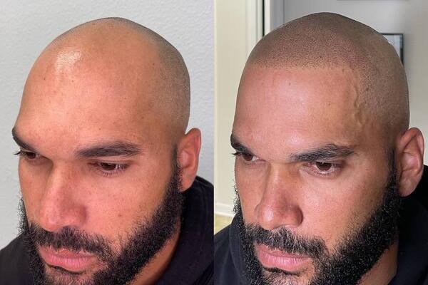 Is SMP Right for You? Key Signs You’re a Good Candidate for Scalp Micropigmentation