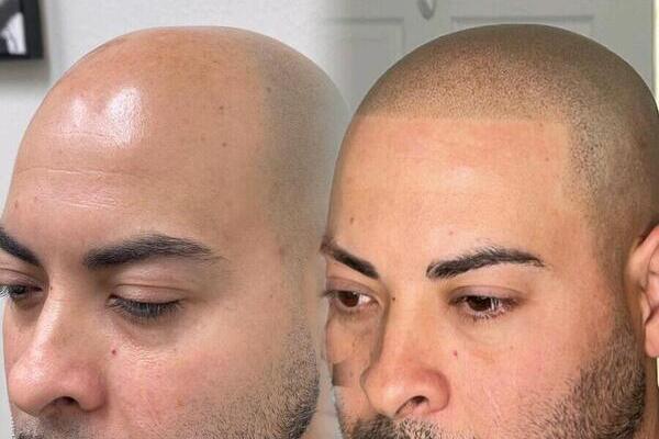 Scalp Micropigmentation Aftercare: How to Maintain Long-Lasting Results