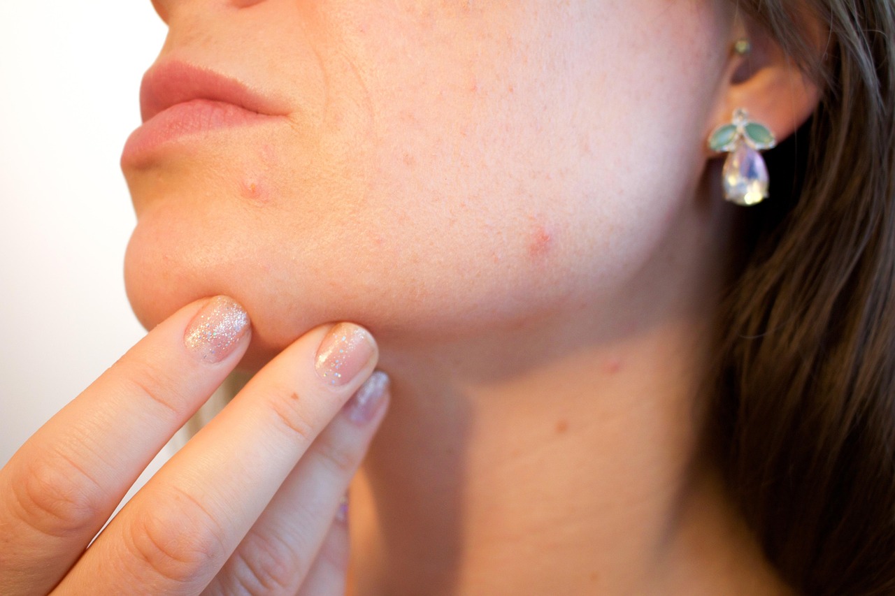 Expert Guide: How to Reduce Appearance of Acne Scars