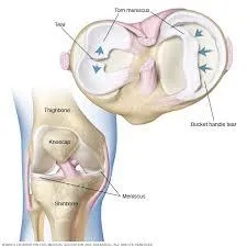 Meniscus Rehab Tips: How to Restore Motion, Build Strength & Return to Running