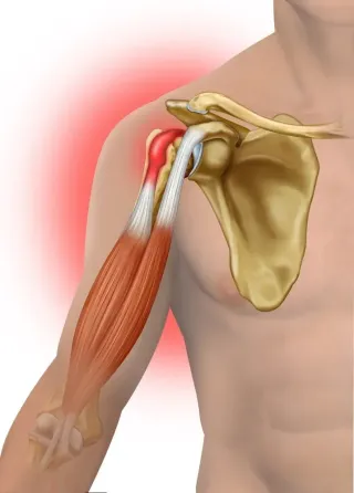 Bicep Tendon & Anterior Shoulder Pain in Pitchers: Tips for A Successful Rehab