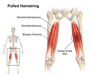 When Can You Start Running After a Hamstring Strain?
