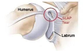 Shoulder Labrum Injuries in Baseball Pitchers