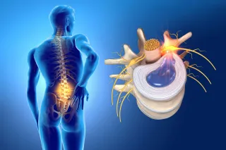 Herniated Disc Without Surgery: A Step-by-Step Guide to Non-Surgical Treatment in Mesquite, TX