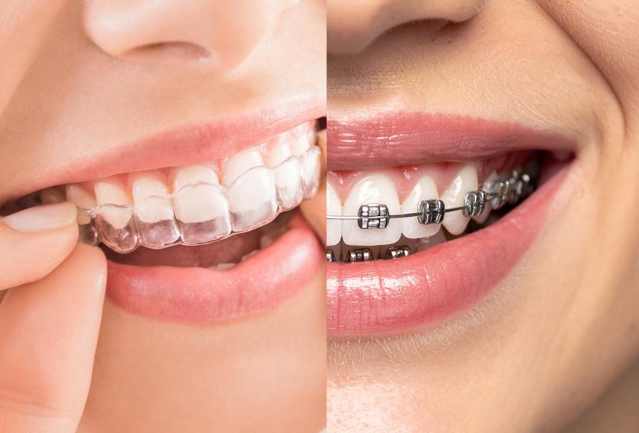 Invisalign vs brackets tradicionales: ¿cuál es mejor?