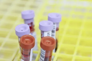E51 Your Blood Work Has A Cancer Marker Hiding In Plain Sight
