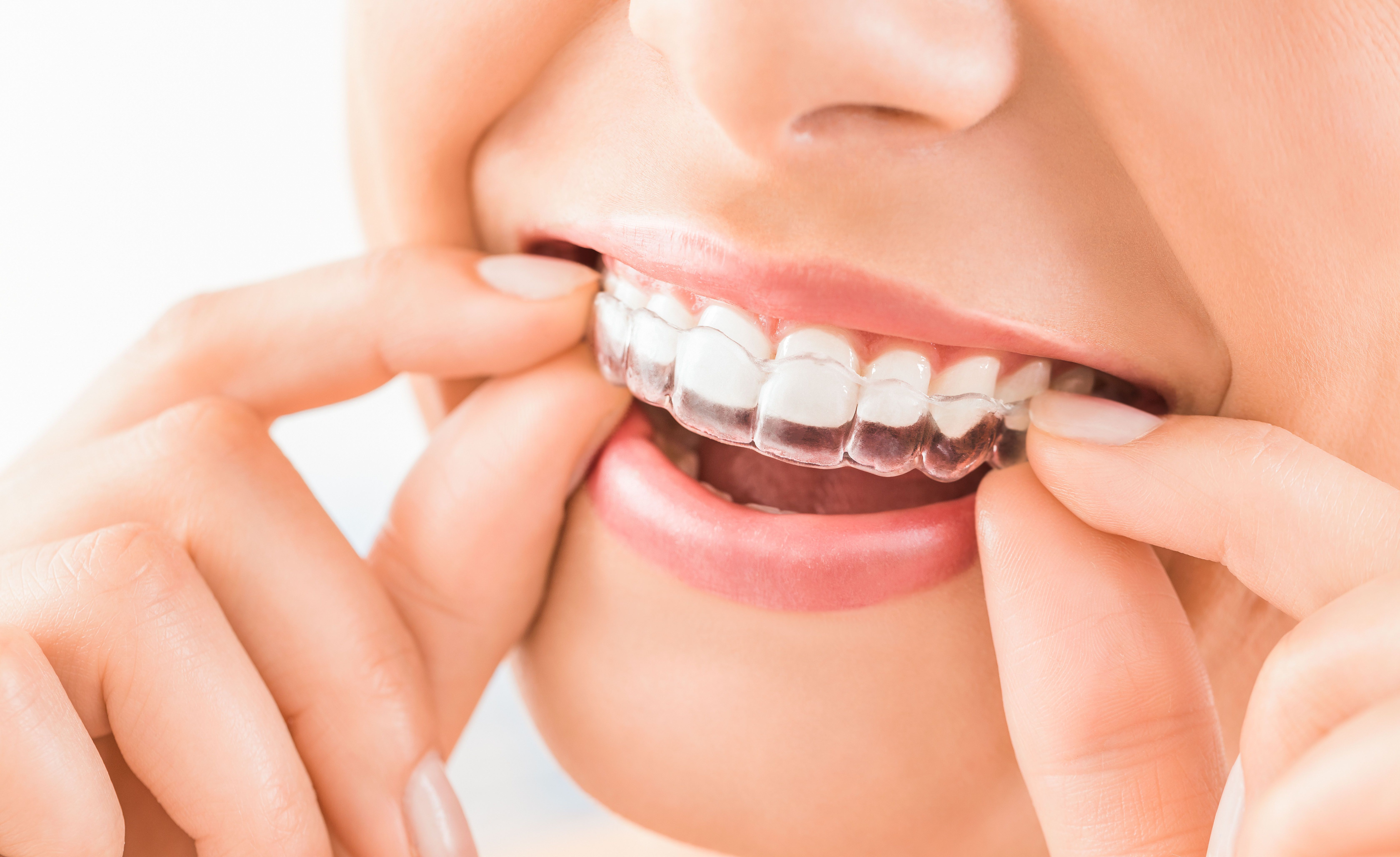 Signs You May Benefit From Invisalign