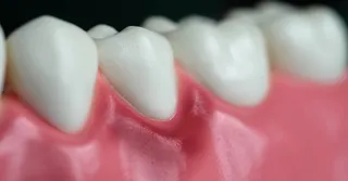 Gum Disease in Singapore: What It Is, Why It Is So Common, and What to Do About It