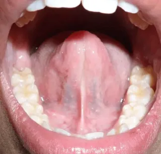 My Tongue Tie Journey | From symptoms to myofunctional therapy and finally a release