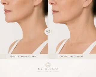 Crepey Skin: Causes, Prevention & Treatment Options | ME MEDSPA