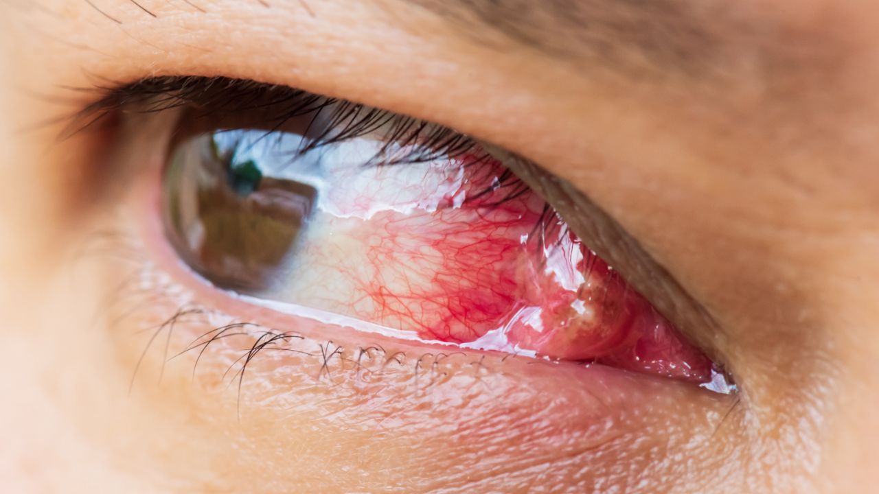 Pterigión: La Carnosidad en el Ojo que Crece y No se Detiene