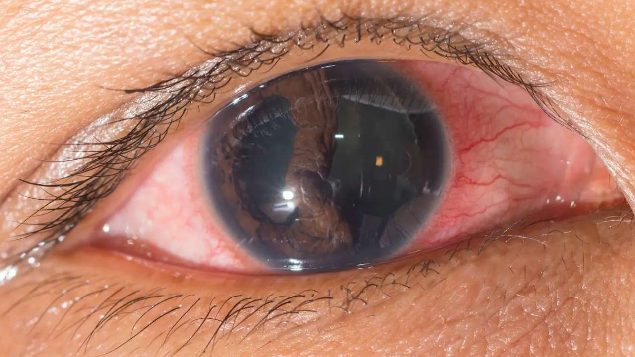 Desprendimiento de Retina: Emergencia que Requiere Acción Ya