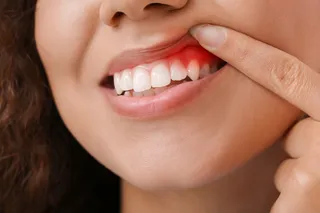 Swollen Gums in Sacramento? Find Emergency Dental Care 24/7