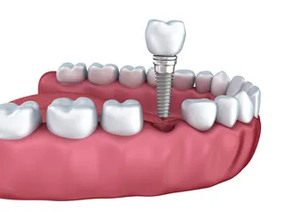Lost a Dental Crown in Panama City, FL? What to Do Next