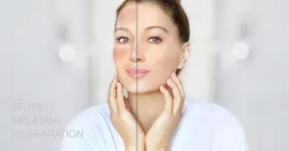 How Aerolase Targets Melasma and Hyperpigmentation for Clearer Skin