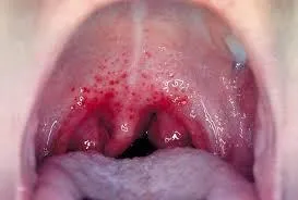 Strep Throat