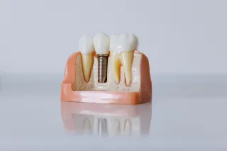 The Complete Guide to Dental Implants: What York Patients Need to Know