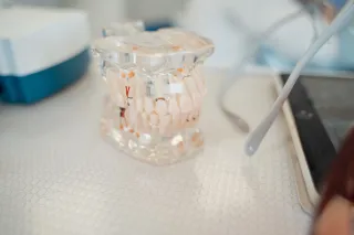 10 Most Common Questions About Dental Implants in Acomb