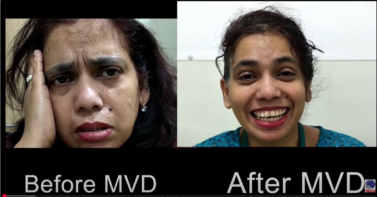 Trigeminal neuralgia pain attack