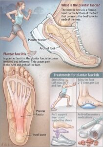 Plantar Fasciitis