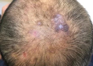 Alopecia Cicatricial
