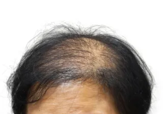 Can You Prevent Hair Loss if it’s Genetic? | Kerri Jarrett, Trichology and Epigeentics