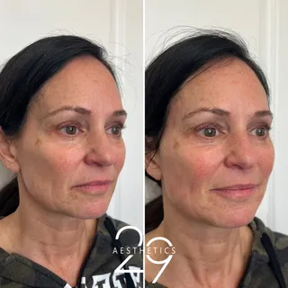 Want to improve fine lines + restore volume without committing to filler? This might be the treatment for you...