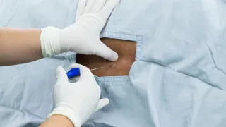 Alternatives to Spinal Fusion Spine Surgery Plano TX: Restoring Motion Without the Fusion