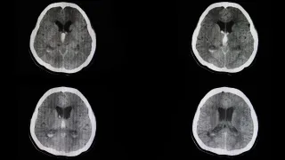 Lewisville TX Spine Surgeon Expert: Providing Advanced Spine Care You Can Trust