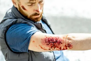 How Columbia Urgent Care Treats Minor Burns & Skin Injuries