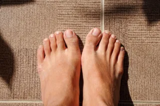 The Connection Between Flat Feet and Bunions: Understanding the Relationship