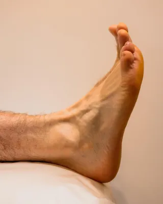Corns And Callus