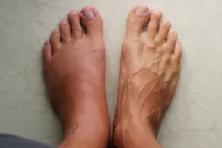 Why You Shouldn't Ignore Persistent Foot Swelling