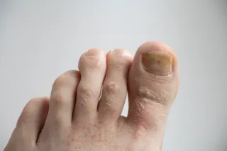 Fungal Nails 101: What Causes Them and How to Treat Them