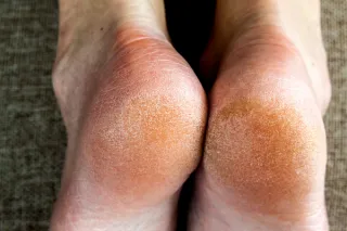 When Hard Skin on Your Feet Becomes a Problem