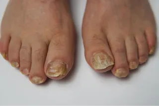 Top 5 Reasons Your Toenails Might Be Thick, Yellow or Crumbly