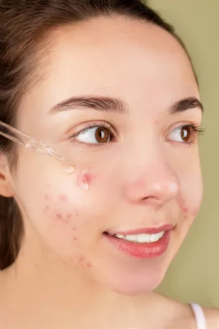 How To Get Rid of Redness From Acne