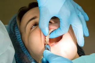 Tooth Extractions: When and Why They’re Necessary