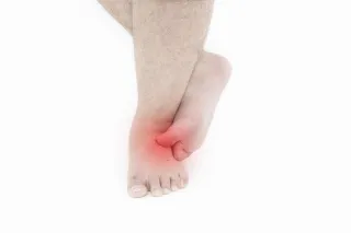Is Athlete's Foot (Tinea Pedis) Related to Toenail Fungus?