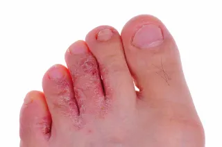 The Link Between Fungal Nails and Athlete’s Foot: What You Need to Know
