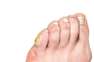 Unlock the Secrets to Corn-Free Feet: Your Ultimate Guide
