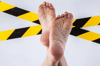 Can Flexible Flat Feet Be Corrected? Understanding Your Options