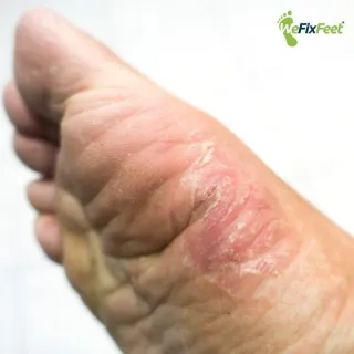 Why Are Fungal Foot Infections Difficult to Treat if Not Addressed Early?