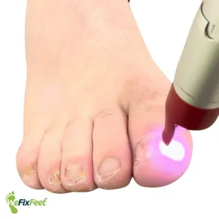 Comprehensive Treatment Options for Fungal Infections of the Feet