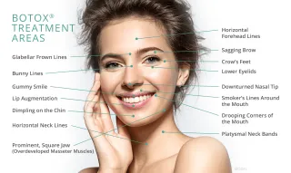 Everything you need to know about Botox - Bella Donna Med Spa
