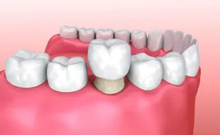 Коронки (круни) во Скопје – Сè што треба да знаете за совршена насмевка со Дентал Студио Арс